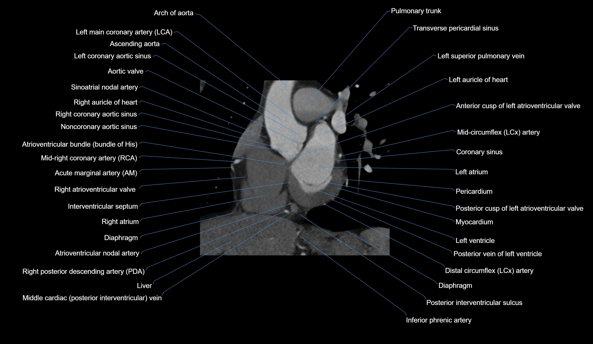 CT heart (coronary angiogram) short axis view  cross sectional anatomy labelled radiology image-00020.webp